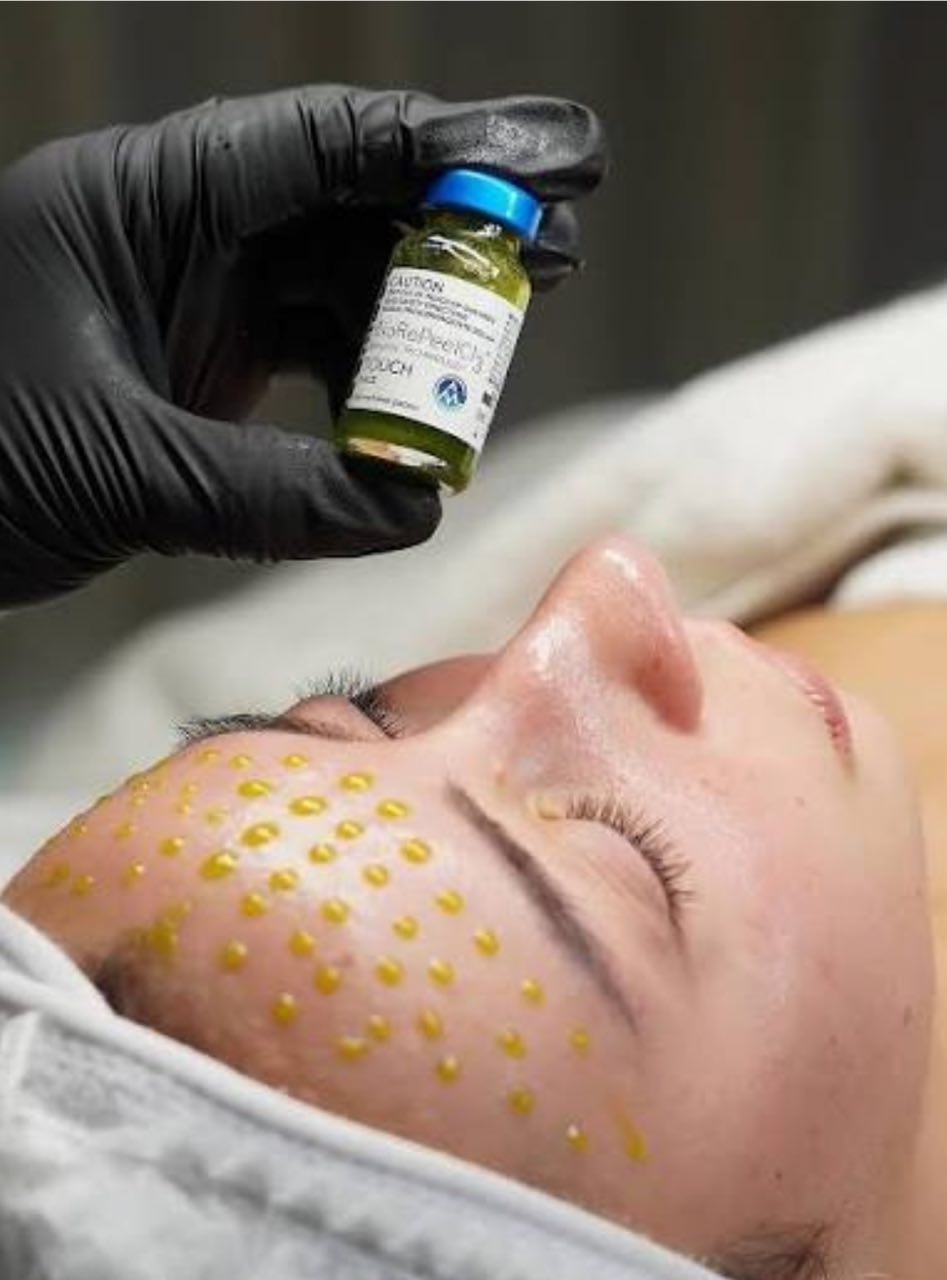 Dermal Biostimulation — BioRePeel / PRX-T33