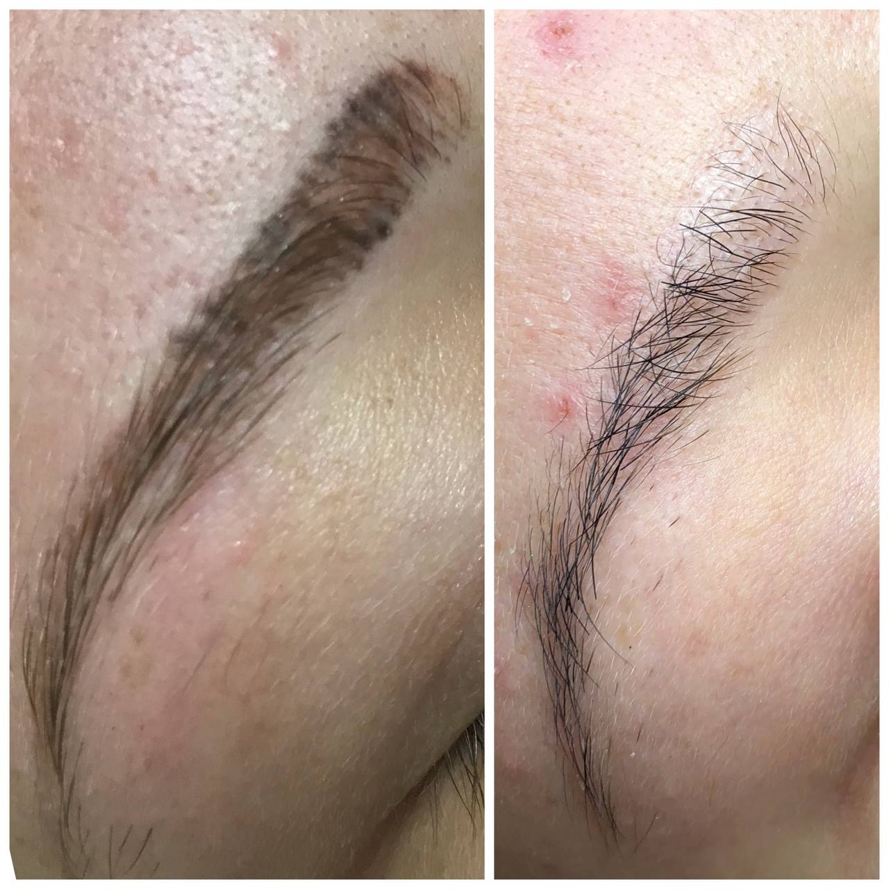 Permanent Makeup Removal — Laser