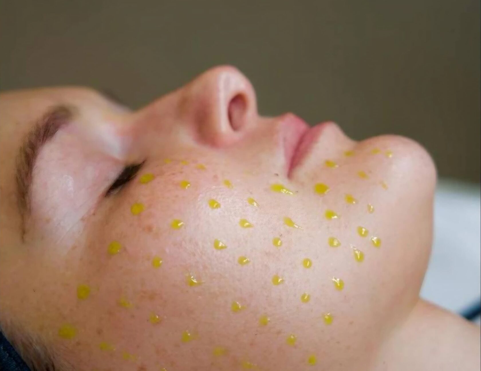 Customized Chemical Peels — Jessner / TCA / Image